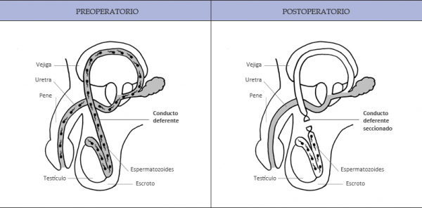 Vasectomía sin Bisturí Vasectomía